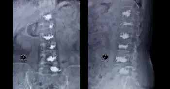 Computerized techniques used to study hyper metabolism in patient with adult spinal deformity: A case report