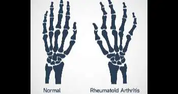 Tumour necrosis factor inhibitors for patients with Methotrexate-Naïve rheumatoid arthritis