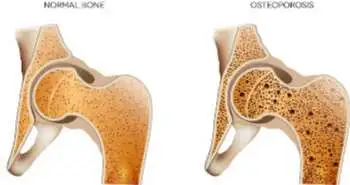 Quantitative Ultrasound is an independent predictor for osteoporosis, explains a propensity score analysis of a longitudinal incident study