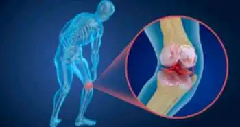 Magnetic Resonance Imaging resolves the choice of treatment for meniscal tears in osteoarthritis