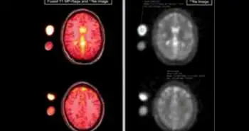 Correlation of neurochemical and imaging markers in migraine via PACAP38 and DTI measures