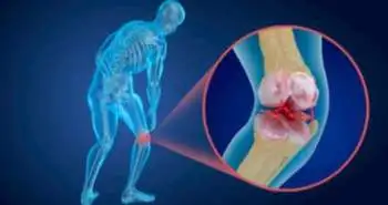 Obesity and sarcopenic obesity could be a risk factor for knee osteoarthritis; sarcopenia devoid off