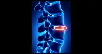 Secukinumab, an interleukin-17a inhibitor, in ankylosing spondylitis