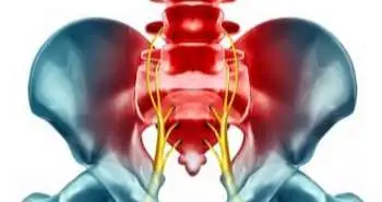 Pain pressure threshold in the region of the sacroiliac joint in patients diagnosed with Sacroiliac Joint Pain