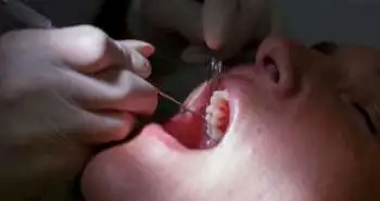 Pain measurement through temperature changes in children undergoing dental extractions