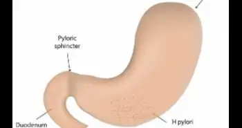 Rifabutin-based triple therapy found to have satisfactory eradication rate in patients with drug-resistant H. pylori