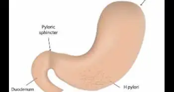 mBCQT and concomitant therapy: First-line treatment options to treat H. pylori