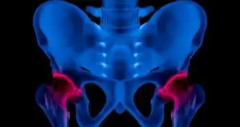 Study evaluates improvements in hip osteoarthritis with lavage, triamcinolone and hylan G-F20