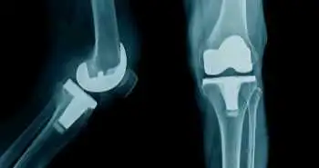 Study demonstrating the augmented wound leakage in total knee arthroplasty with local infiltrative analgesia