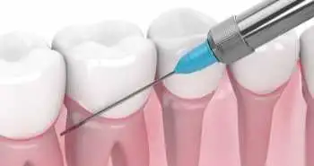 Novel intraoral vibratory device vs. lignocaine hydrochloride gel during inferior alveolar nerve block