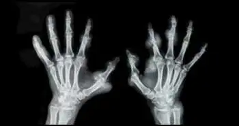 Sarilumab found effective over 5 years in rheumatoid arthritis patients refractory to TNF inhibitors