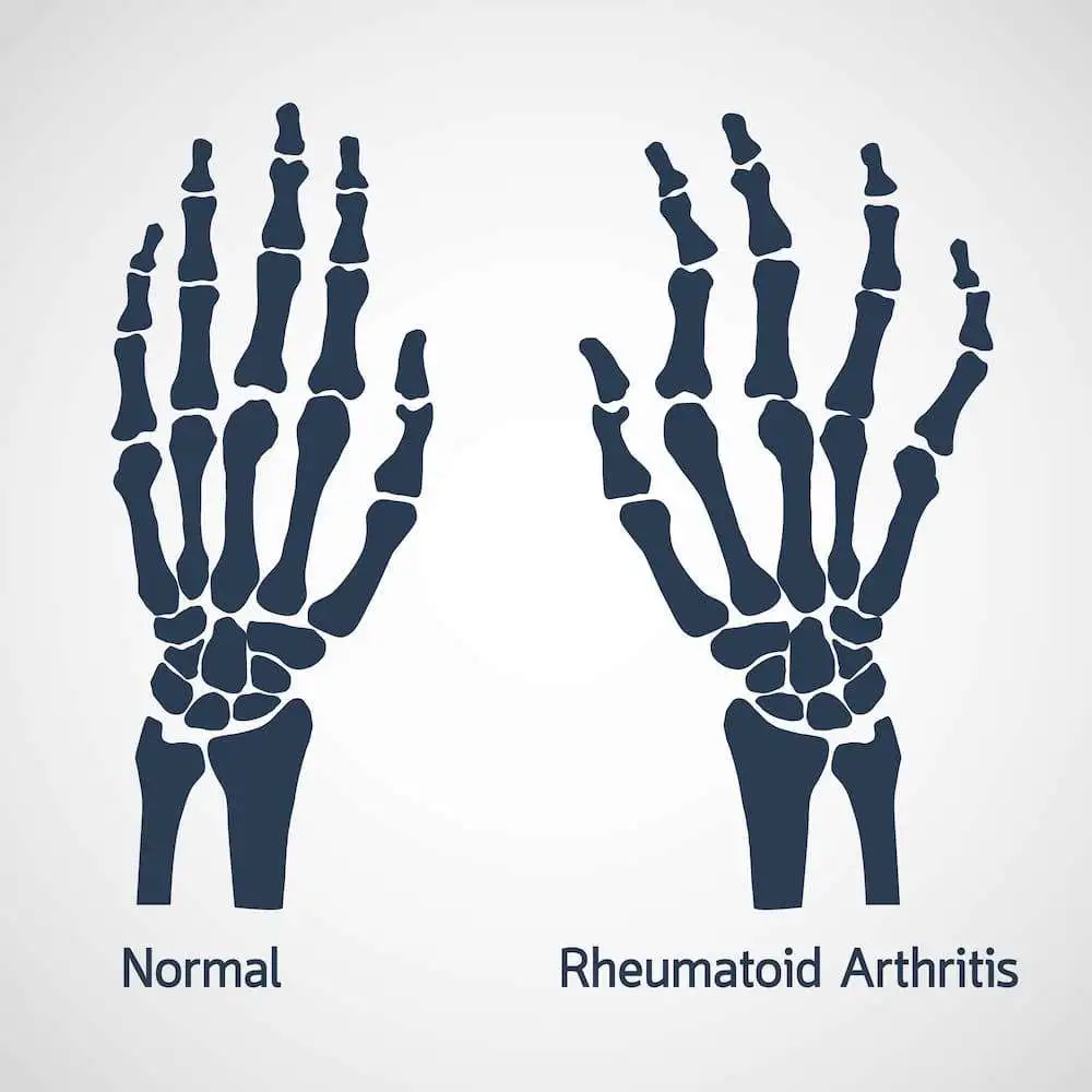 Massive pleural effusion: a rare presentation of rheumatoid arthritis