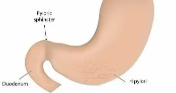 Comparison of esomeprazole and lansoprazole-based non-bismuth concomitant quadruple therapy to treat H. pylori