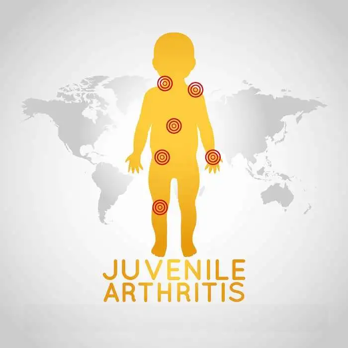 EULAR/PRES standards and recommendations for the transitional care of young people with juvenile-onset rheumatic disease