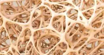 Oral bisphosphonate found useful for secondary prevention of glucocorticoid-induced osteoporosis