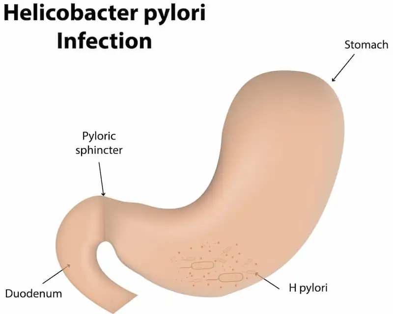 H.pylori