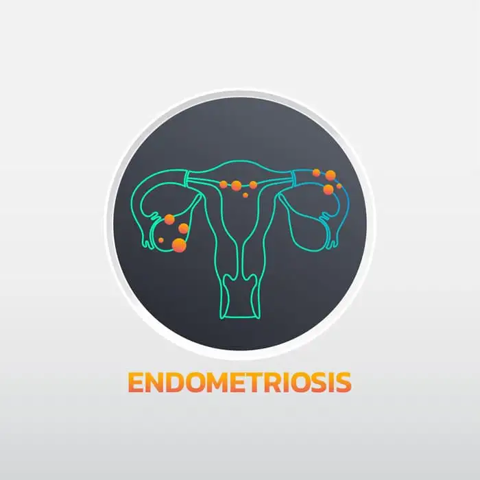 endometriosis