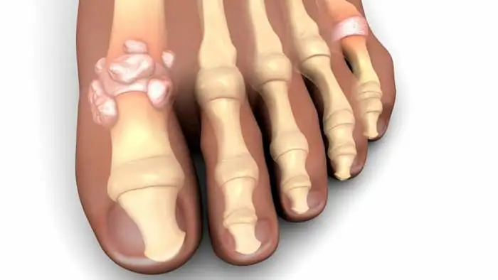 gout_Topiroxostat