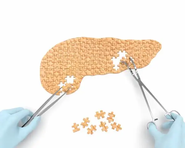 Acute Cholecystitis