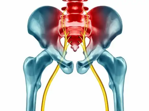 Sciatica