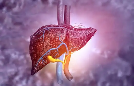 Compensated NASH cirrhosis