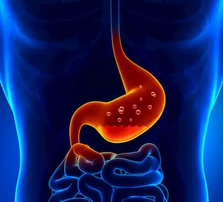 Functional dyspepsia