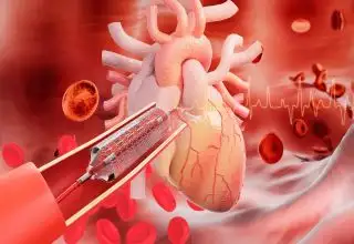 Percutaneous Coronary Intervention