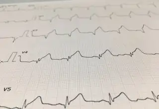 Ventricular arrhythmias