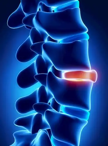 Herniated disc