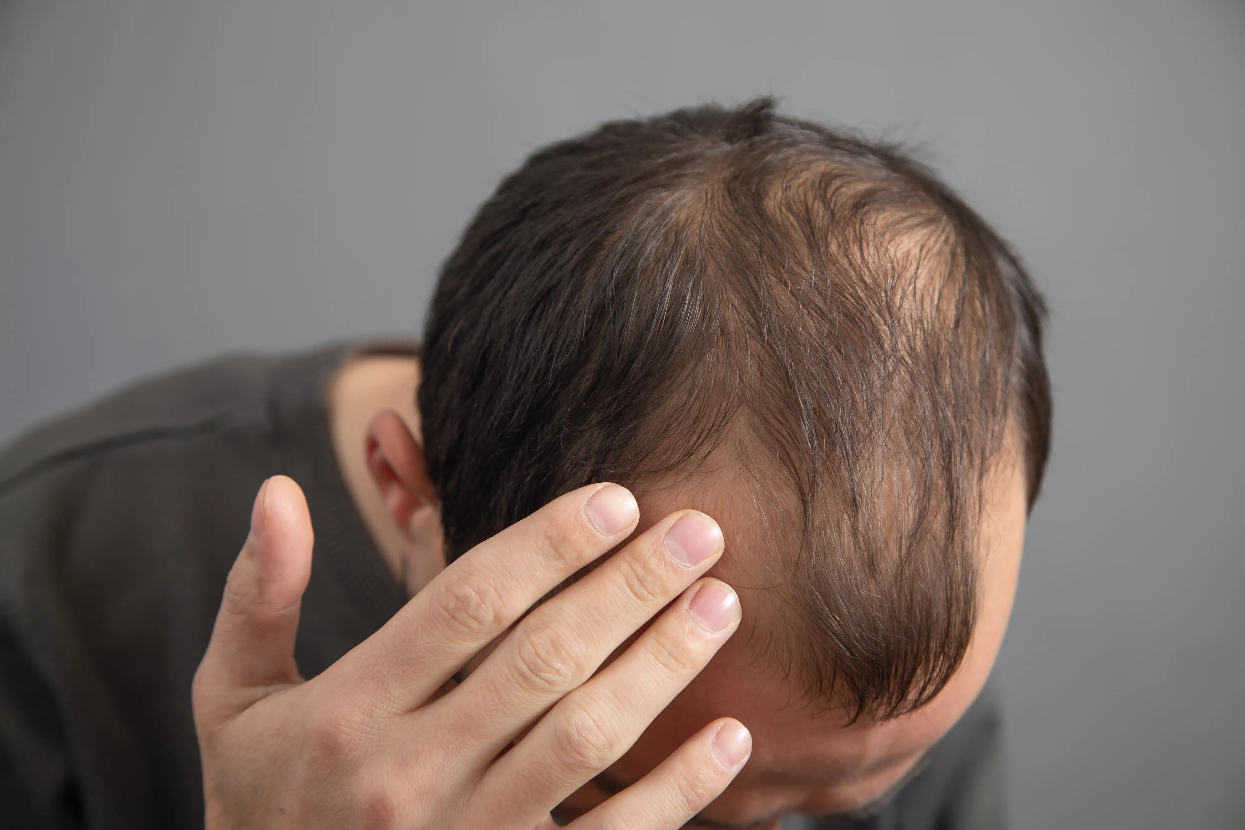 Minoxidil for hair loss