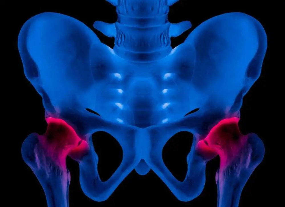 Teriparatide vs. Risedronate in reducing the pain and time of TUG test