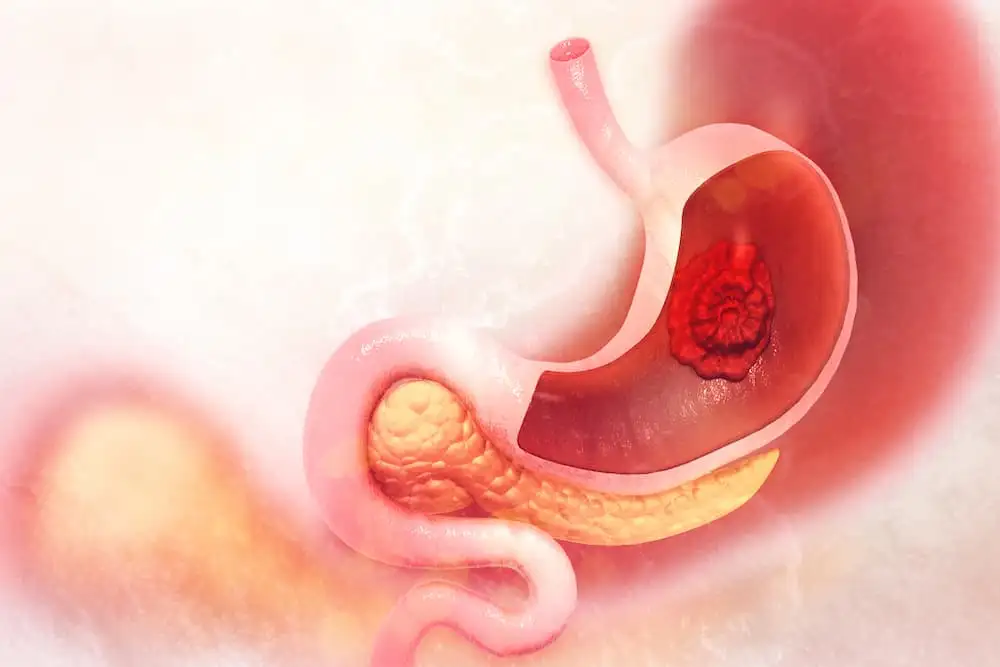 Gastric mucosal damage