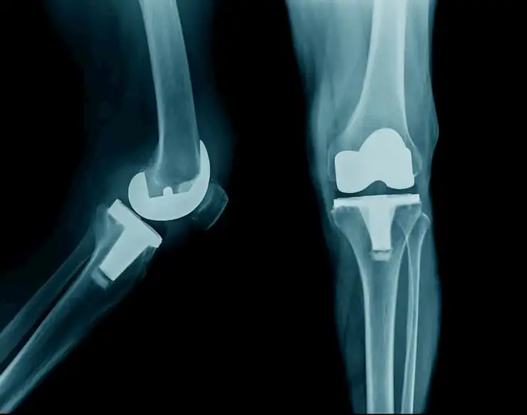 Knee osteoarthritis