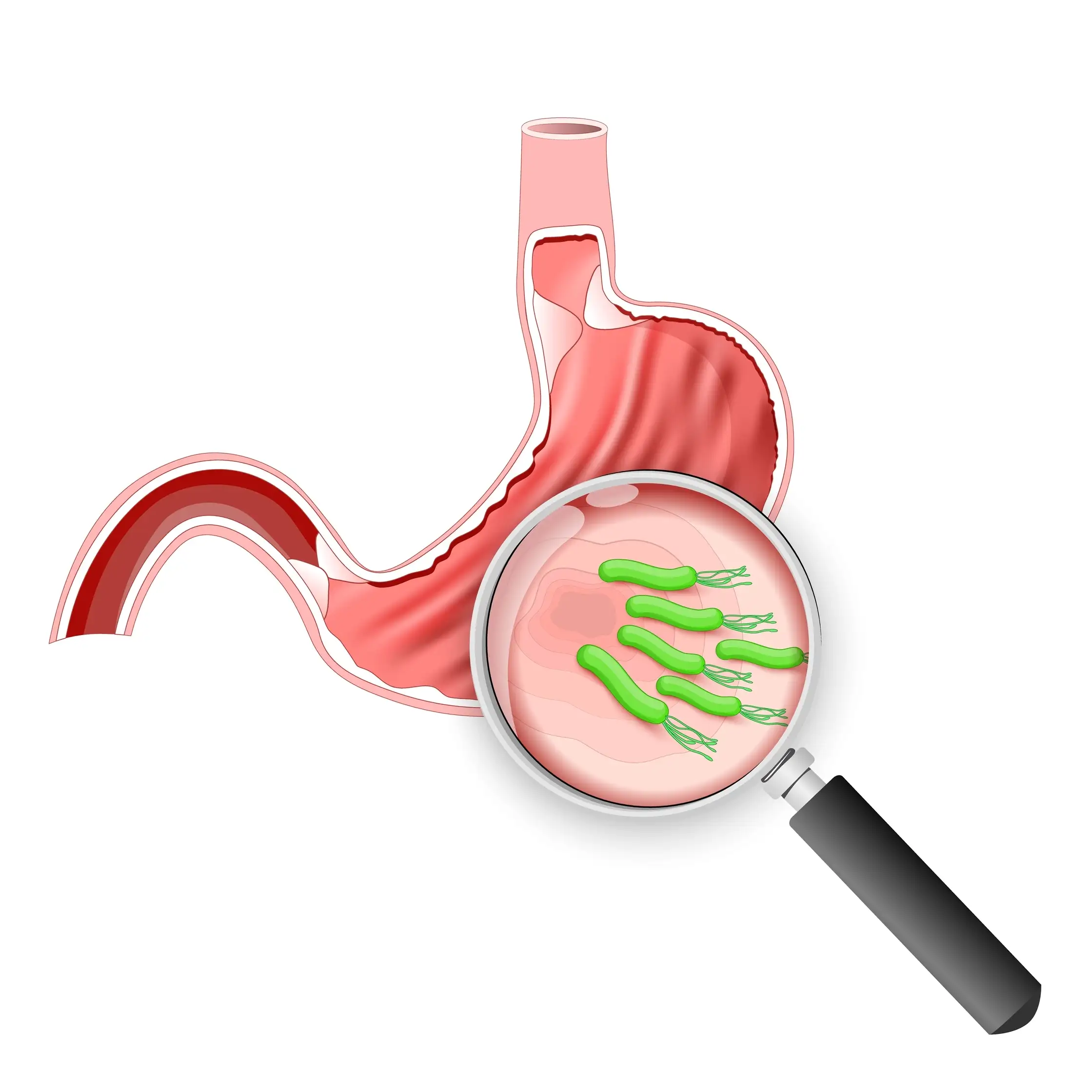 інфекція Helicobacter pylori