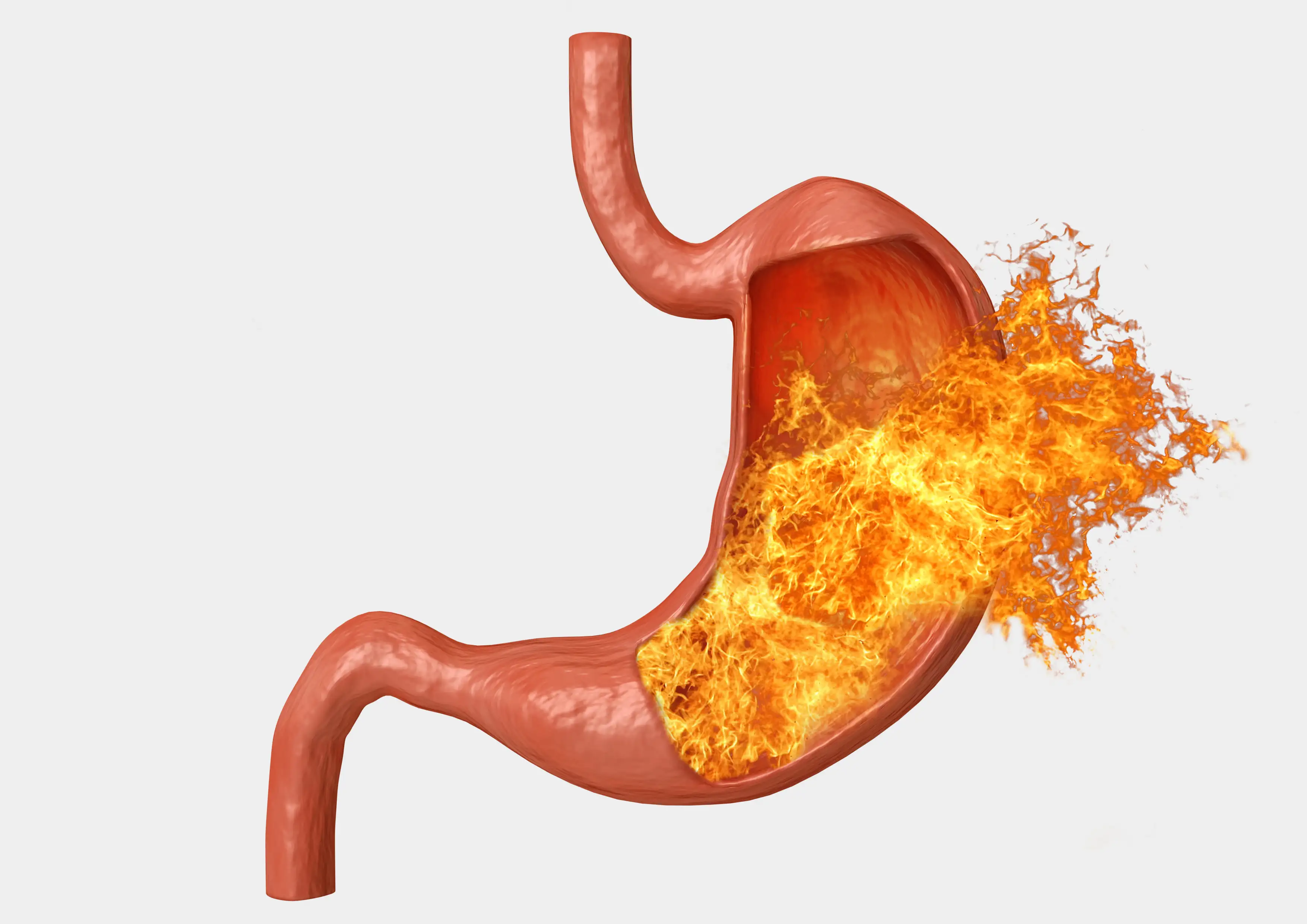 Gastroesophageal reflux disease