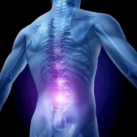 Ankylosing spondylitis