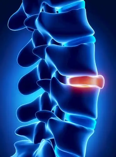 Lumbar spinal stenosis