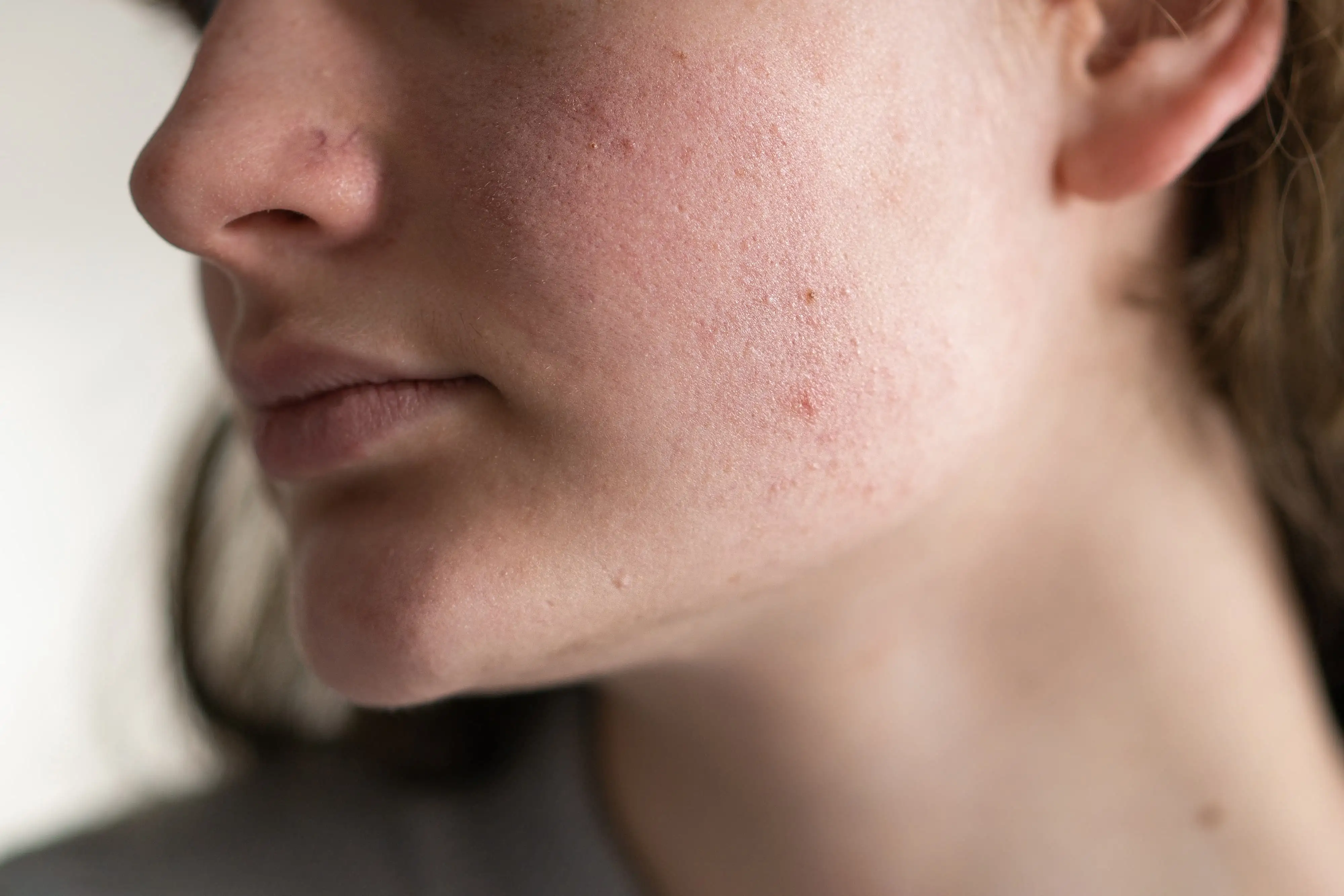 Post Acne Erythema