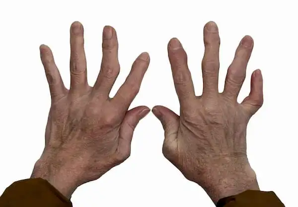 Rheumatoid arthritis