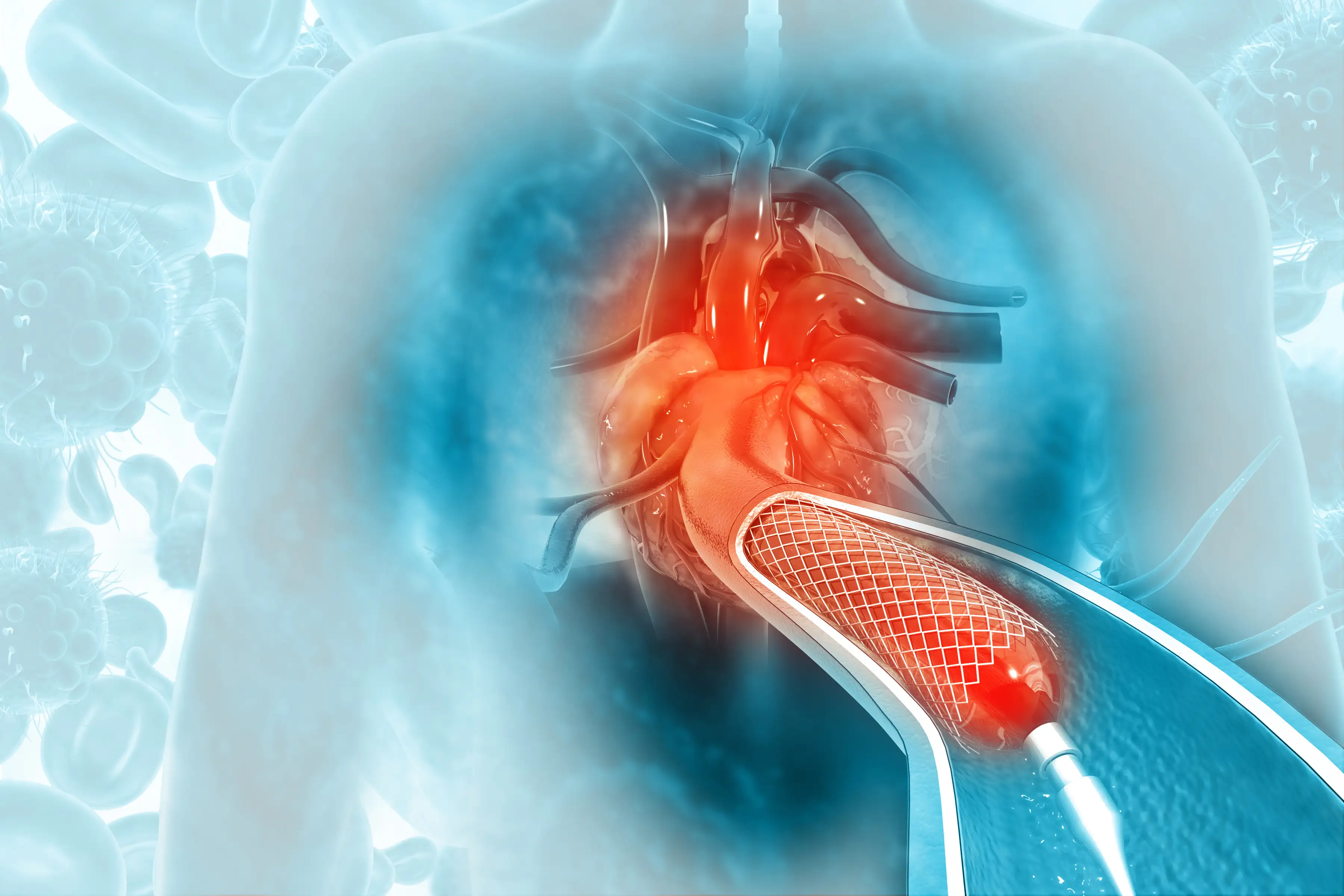 Ischemic heart disease