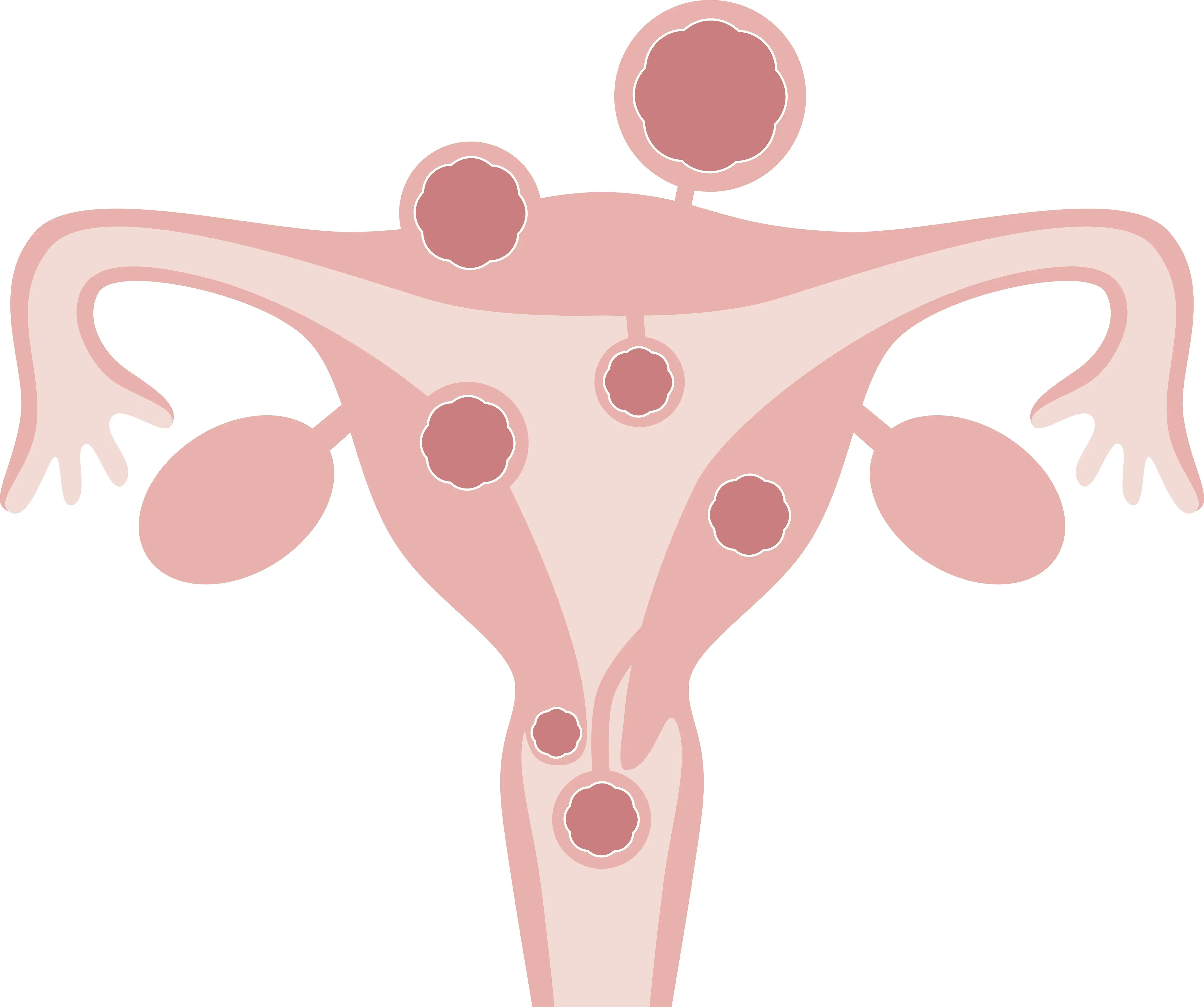 Uterine fibroids