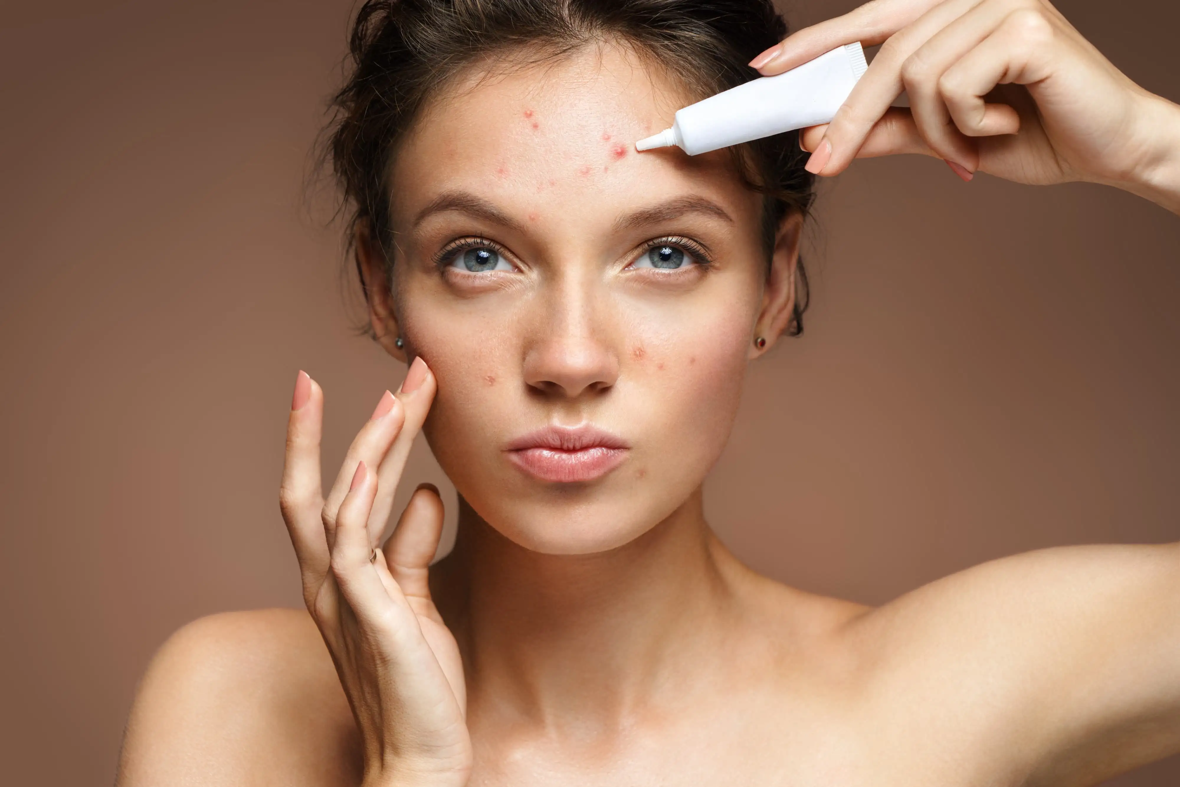 Acne vulgaris recommendations