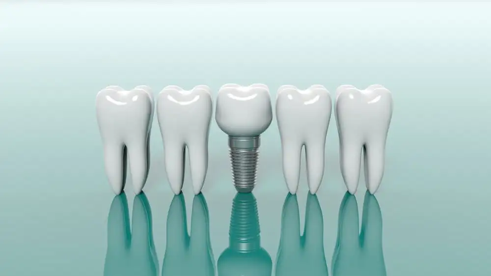 Dental implant surgery