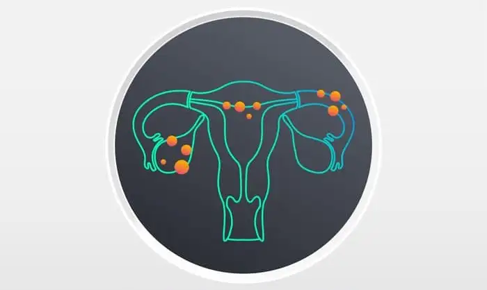 Endometriosis