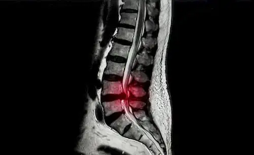 Lumbar degenerative diseases