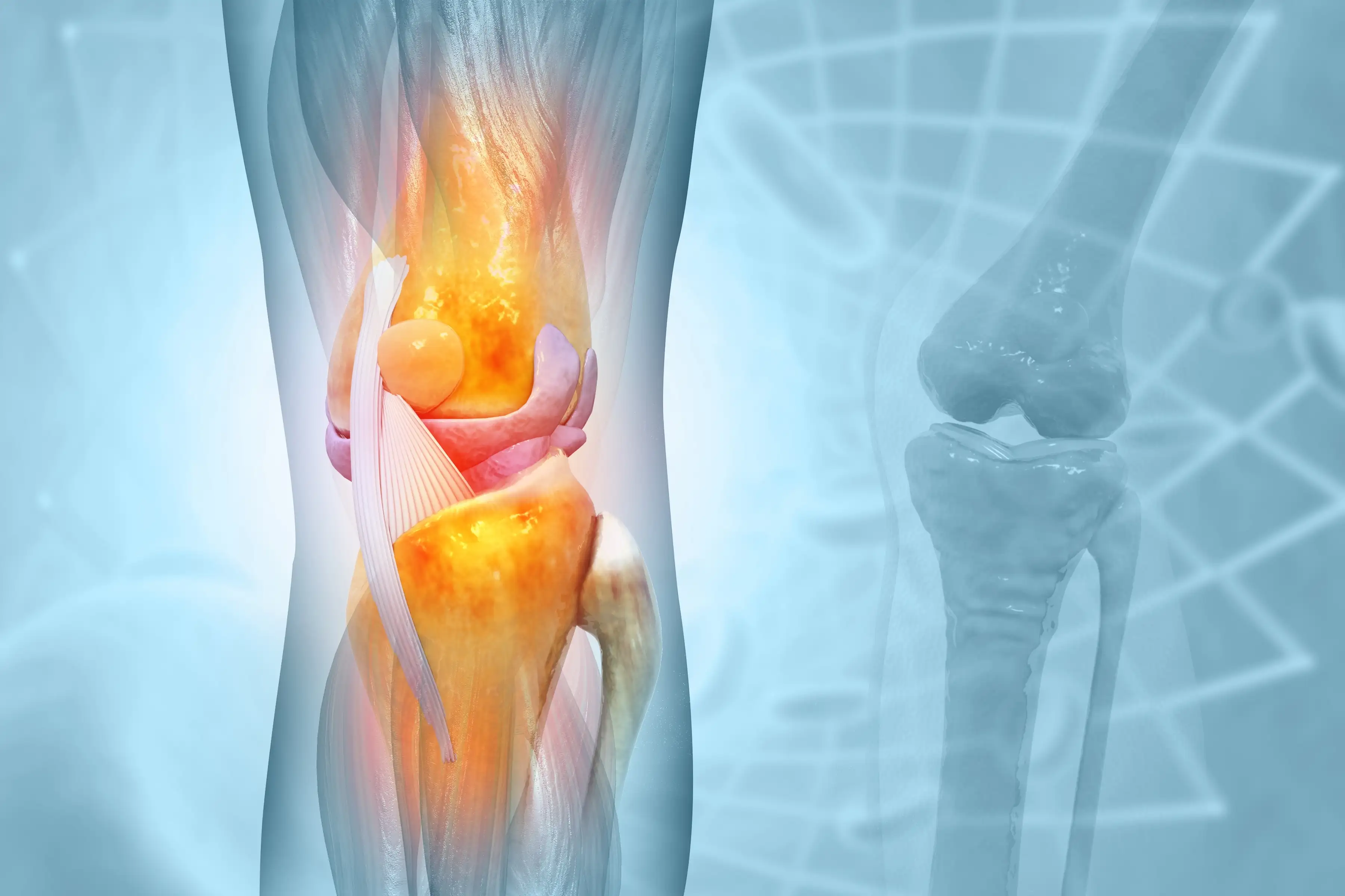 Knee osteoarthritis