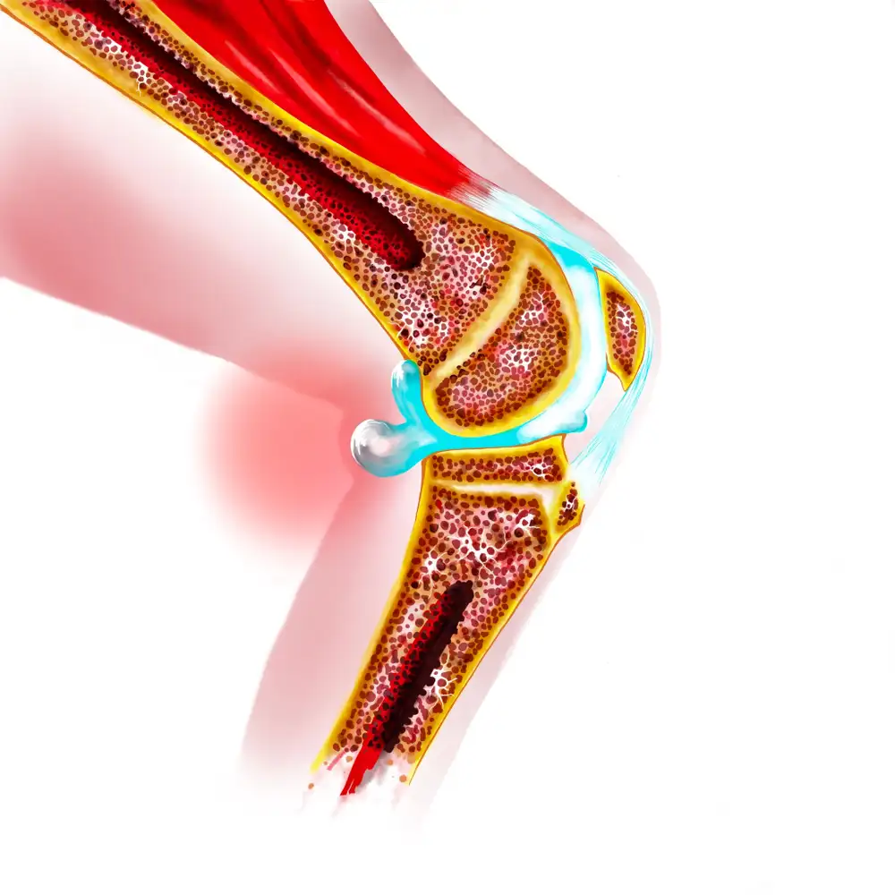 Knee osteoarthritis