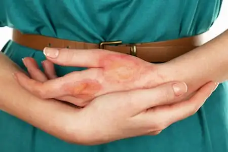 Hand eczema